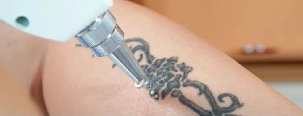 tatuagem sendo removida à laser