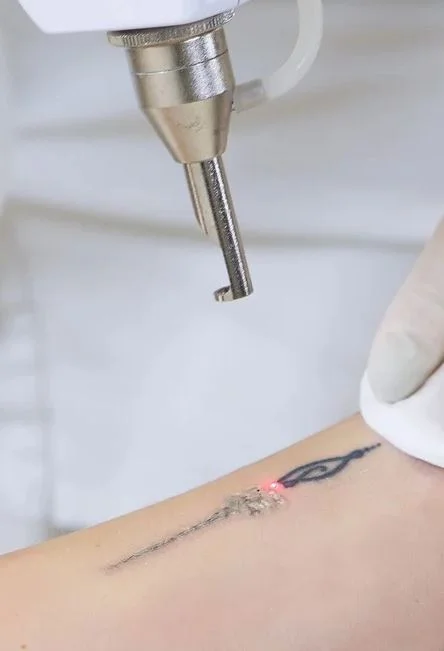 laser de remoção de tattoo